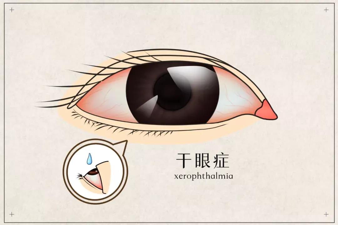 干眼患者福音來(lái)啦！(圖2)